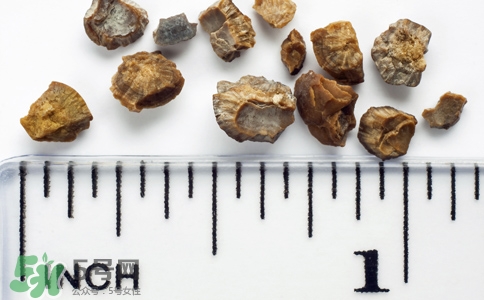 腎結(jié)石有什么癥狀？腎結(jié)石原因