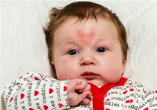 寶寶胎記是怎么來的？寶寶胎記是怎么形成的？