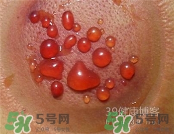 拔火罐有水泡是為什么?水泡要怎么處理? 拔火罐有水泡是為什么?水泡要怎么處理?