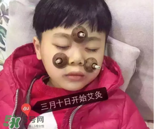 艾灸貼可以治咳嗽嗎？艾灸貼可以治退燒嗎？