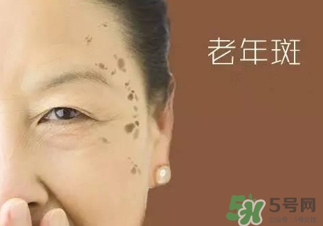 老年斑多大年齡開始有？為什么牙膏能去老年斑？