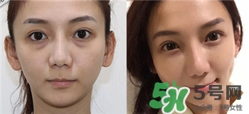 淚溝怎么祛除?淚溝的祛除 淚溝怎么祛除?淚溝的祛除
