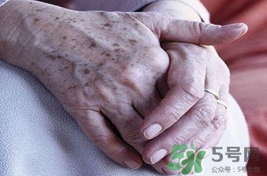 老年斑多大年齡開始有？為什么牙膏能去老年斑？