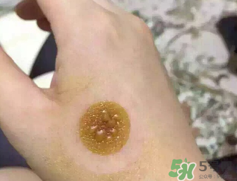 艾灸貼后有水泡怎么辦？貼艾灸貼應(yīng)注意些什么？