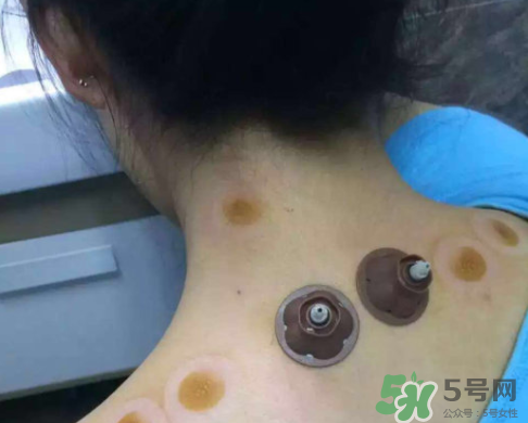 艾灸貼后有水泡怎么辦？貼艾灸貼應(yīng)注意些什么？