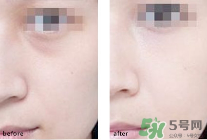 淚溝能自己恢復(fù)嗎？淚溝怎么自己恢復(fù)？