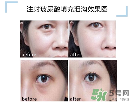 玻尿酸填充淚溝多久恢復(fù)自然？玻尿酸填充淚溝的危害