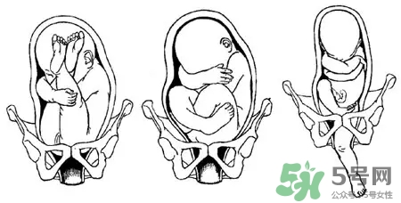 胎位不正能順產(chǎn)嗎？胎位不正怎么辦？