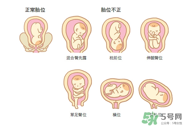 胎位不正如何矯正？胎位不正一定要剖腹產(chǎn)嗎？