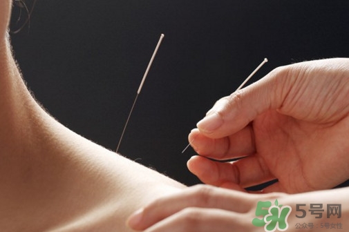 針灸可以天天扎嗎？針灸可以每天扎嗎