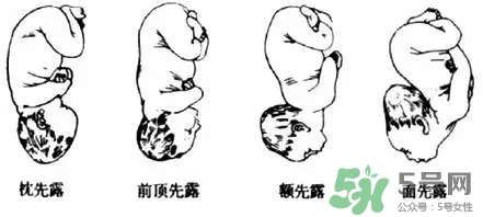 胎位不正能順產(chǎn)嗎？胎位不正怎么辦？