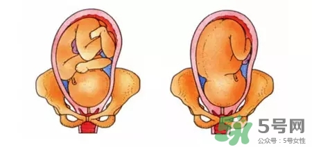 胎位不正能順產(chǎn)嗎？胎位不正怎么辦？