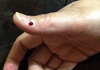 什么人不能做放血療法？放血療法有什么功效？