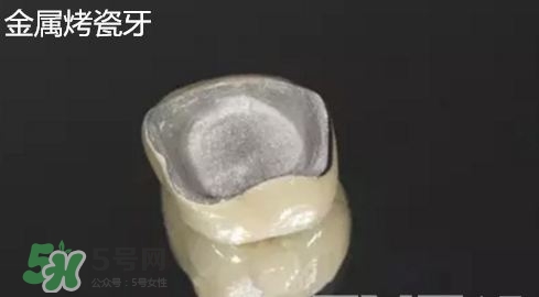 烤瓷牙和全瓷牙有什么區(qū)別?烤瓷牙和全瓷牙的區(qū)別 烤瓷牙和全瓷牙有什么區(qū)別?烤瓷牙和全瓷牙的區(qū)別