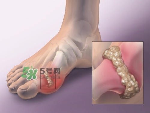 艾艾貼能治痛風(fēng)嗎？艾艾貼治風(fēng)濕嗎？