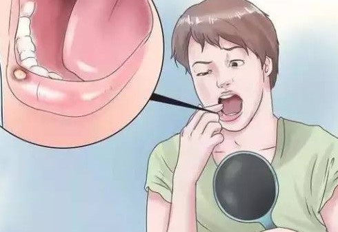 口腔潰瘍牙齦腫痛怎么辦？口腔潰瘍是什么樣子