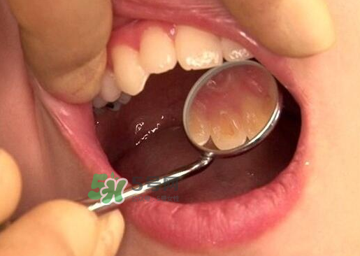 三伏天可以拔牙嗎嗎?三伏天拔牙好嗎？