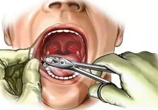 三伏天可以拔牙嗎嗎?三伏天拔牙好嗎？