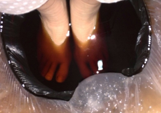 醋泡腳用白醋還是陳醋？泡腳用什么醋最好？