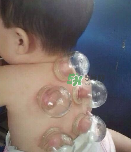 拔火罐后顏色多久消失？拔火罐印子多久能消除？