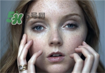 雀斑為什么越來(lái)越多?促使雀斑越來(lái)越多的原因 雀斑為什么越來(lái)越多?促使雀斑越來(lái)越多的原因