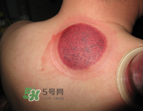 三伏天拔罐后多久可以洗澡？三伏天拔罐后注意事項(xiàng)