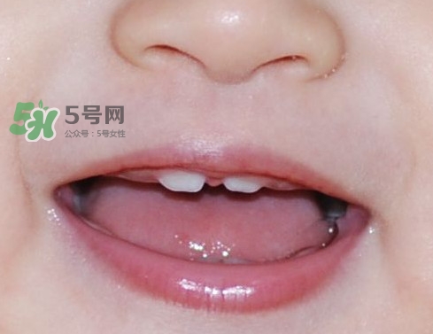 牙齒縫隙大怎么辦？牙縫大帶牙套有用嗎