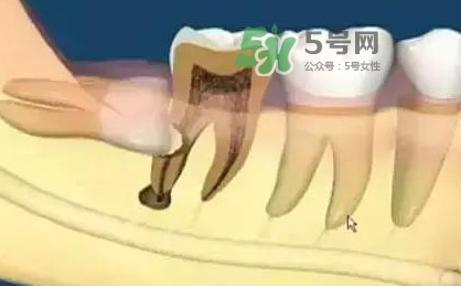 智齒是每個(gè)人都會(huì)長嗎？拔智齒能瘦臉嗎？