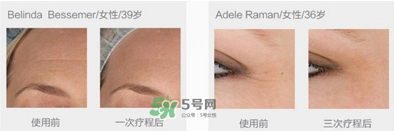 tripollar怎么樣 tripollar怎么用 tripollar怎么樣 tripollar怎么用