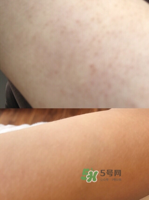 去雞皮膚產(chǎn)品怎么選擇 去雞皮膚產(chǎn)品使用步驟 去雞皮膚產(chǎn)品怎么選擇 去雞皮膚產(chǎn)品使用步驟