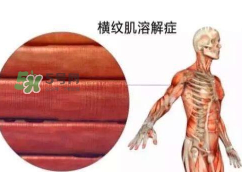 橫紋肌溶解癥會(huì)死亡嗎？橫紋肌溶解癥能活多久