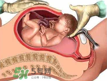 剖腹產比順產安全嗎？剖腹產產后注意事項？