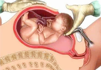 剖腹產(chǎn)比順產(chǎn)安全嗎？剖腹產(chǎn)產(chǎn)后注意事項？