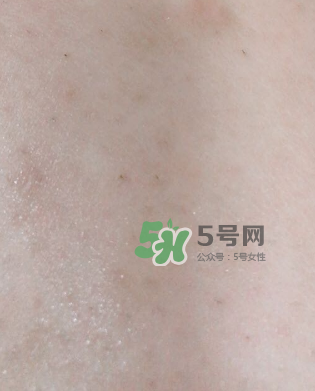 Dermatix舒痕疤痕膏有效嗎？Dermatix舒痕疤痕膏怎么用？