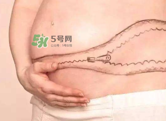 剖腹產(chǎn)疤痕怎么去除？剖腹產(chǎn)疤痕能去掉嗎？