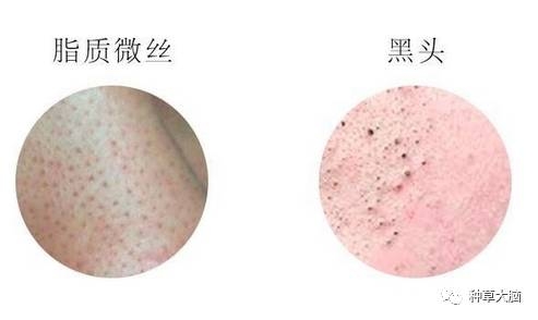 小氣泡是什么 小氣泡去黑頭有效嗎 小氣泡是什么 小氣泡去黑頭有效嗎