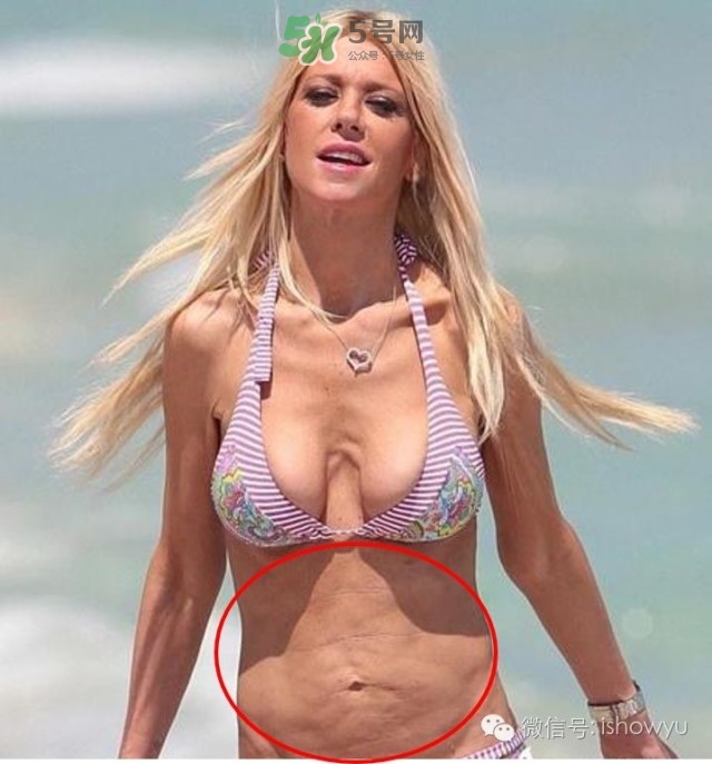 酷塑溶脂效果對(duì)比圖片 酷塑溶脂全過程記錄 酷塑溶脂效果對(duì)比圖片 酷塑溶脂全過程記錄