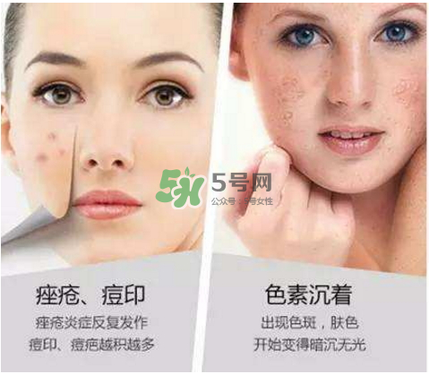 果酸換膚自己可以做嗎？果酸換膚后注意事項(xiàng)