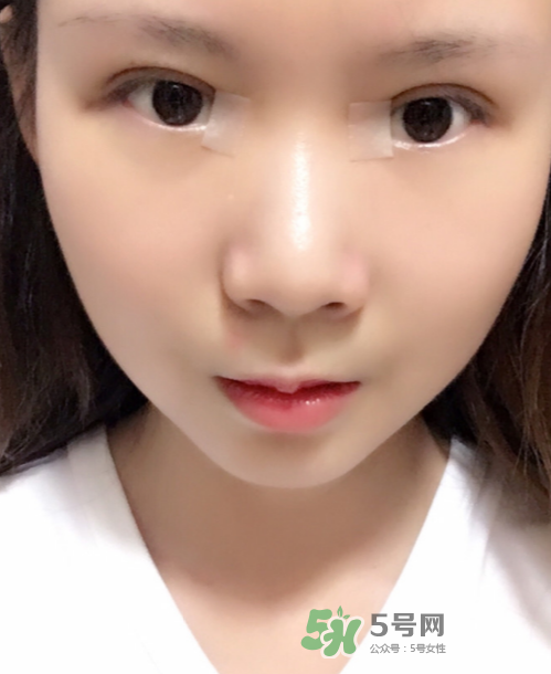 美皮護(hù)去疤效果怎么樣？美皮護(hù)有用嗎？