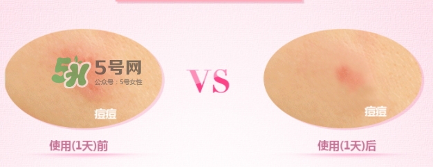 3m痘痘貼怎么用？3m痘痘貼貼多久？