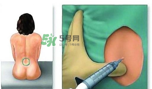 無痛分娩為什么不提倡？無痛分娩有后遺癥嗎？