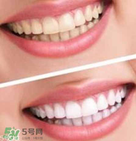 碧緹福美牙儀對牙齒有傷害嗎？碧緹福美牙儀會反彈嗎？