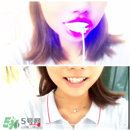 美牙儀能治氟斑牙嗎？氟斑牙可以用美白儀嗎？