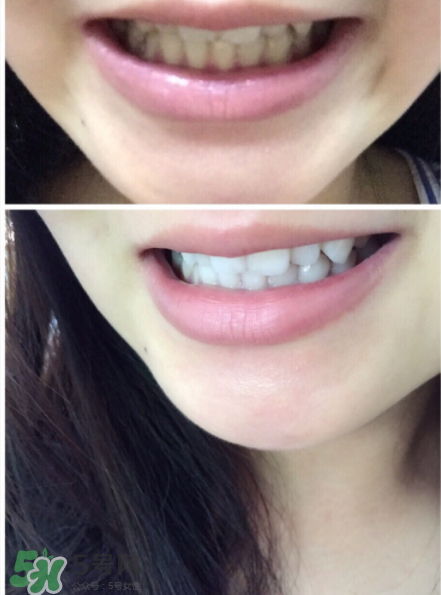 美牙儀能用水洗嗎？美牙儀能用多久？