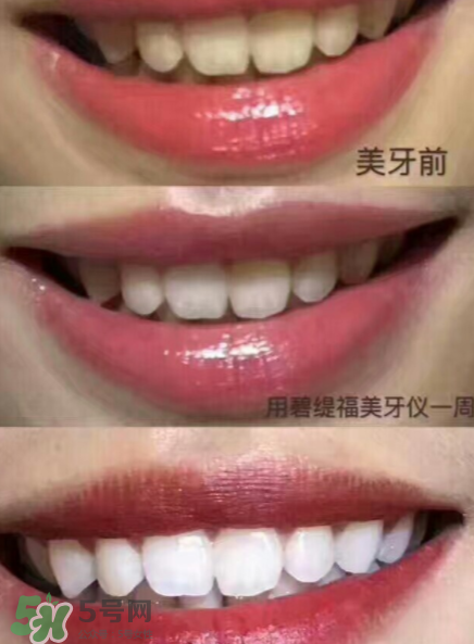 美牙儀能用水洗嗎？美牙儀能用多久？