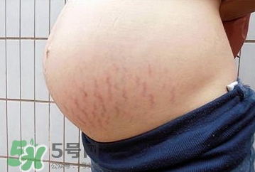 妊娠紋什么時候開始預(yù)防？妊娠紋什么時候消除？