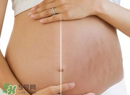 脖子上會(huì)長(zhǎng)妊娠紋嗎？妊娠紋長(zhǎng)在哪些地方？