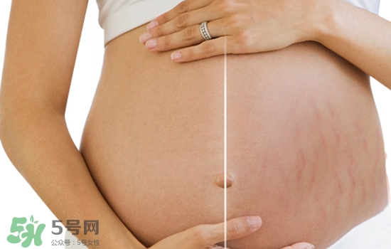 妊娠紋在左邊生男或女？怎么從妊娠紋看男女？