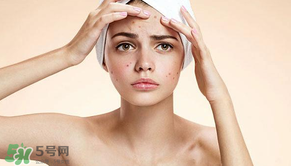 長痘長閉口怎么辦？長痘長閉口是什么原因？