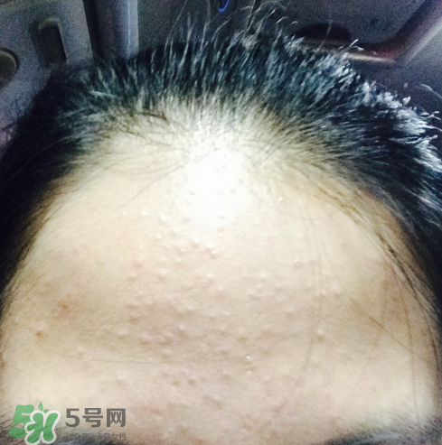 長痘長閉口怎么辦？長痘長閉口是什么原因？